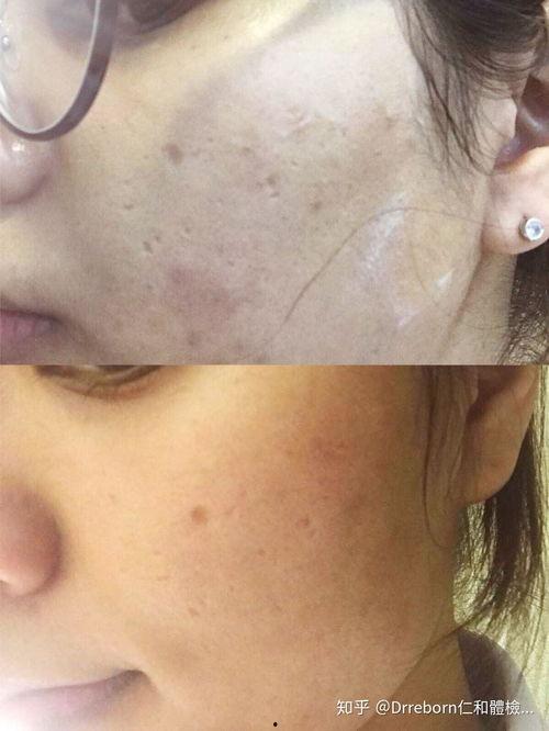 蜂巢皮秒视频,揭秘高效激光美容的秘密武器